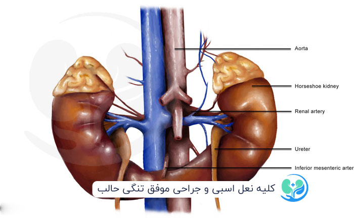 کلیه نعل اسبی و جراحی تنگی حالب توسط دکتر حسین رجبی