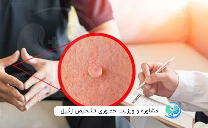 مشاوره و ویزیت حضوری تشخیص زگیل