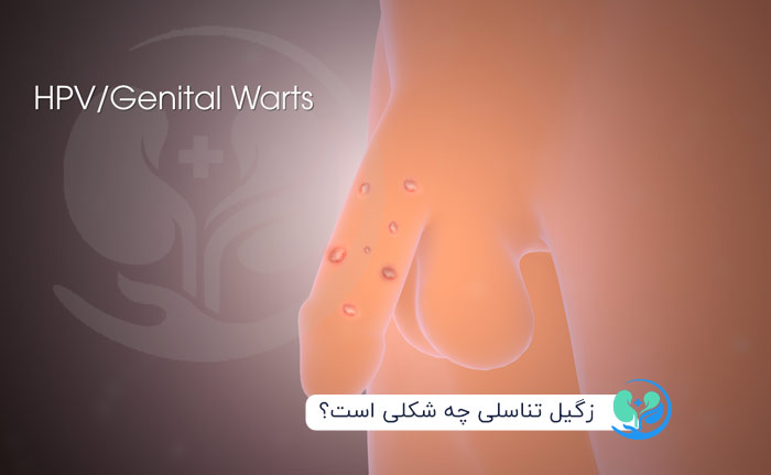 زگیل تناسلی چه شکلی است